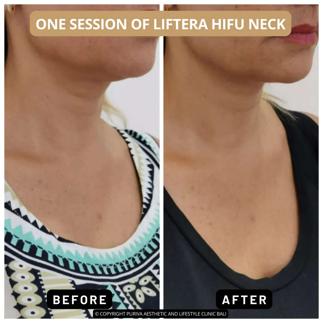 Before and after Liftera HIFU Neck Lifting