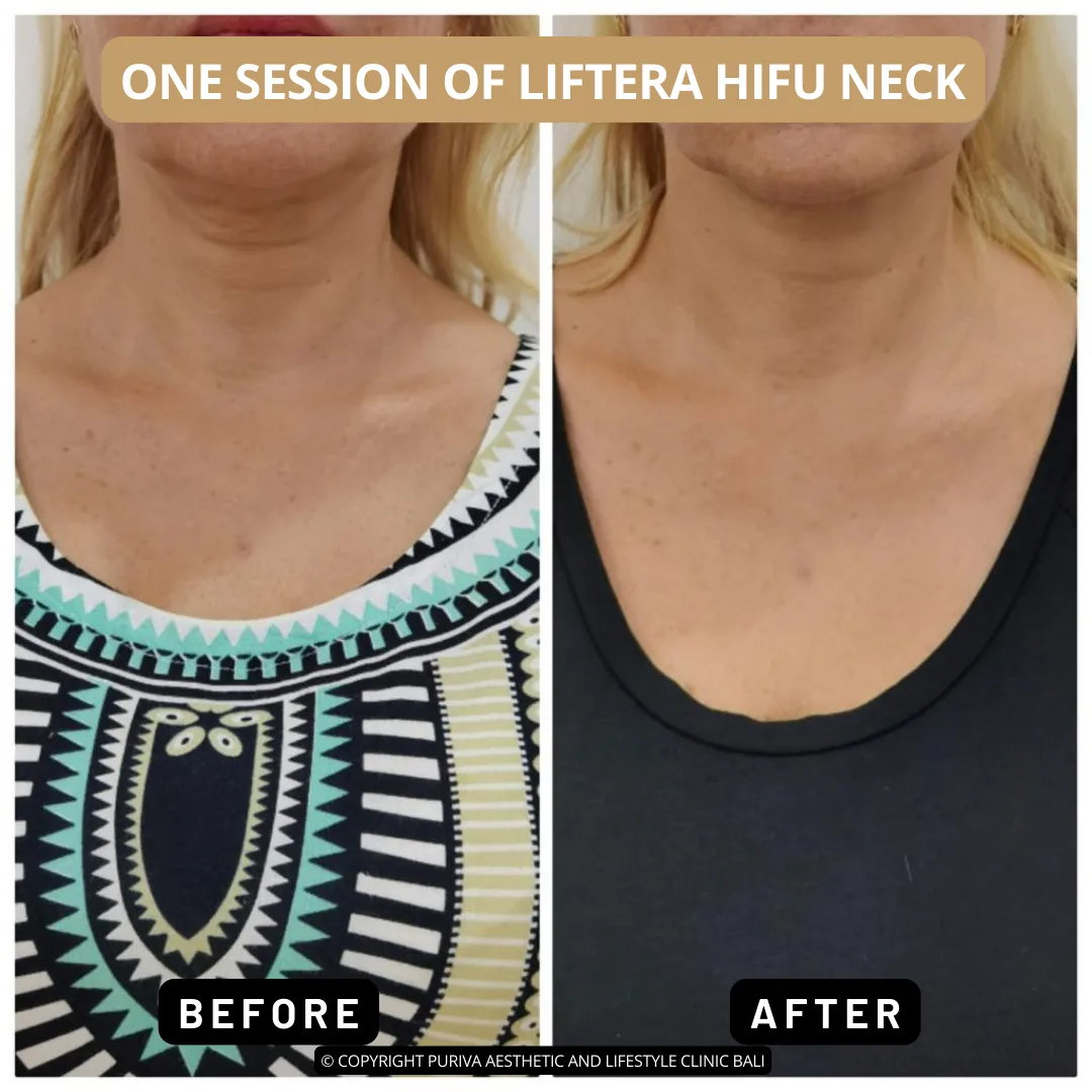 Before and after Liftera HIFU Neck