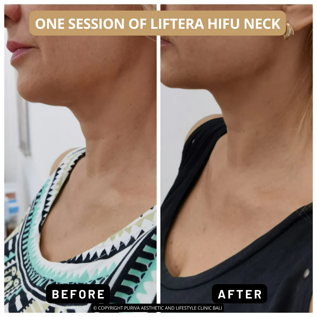 Before and after Liftera HIFU Neck in Bali