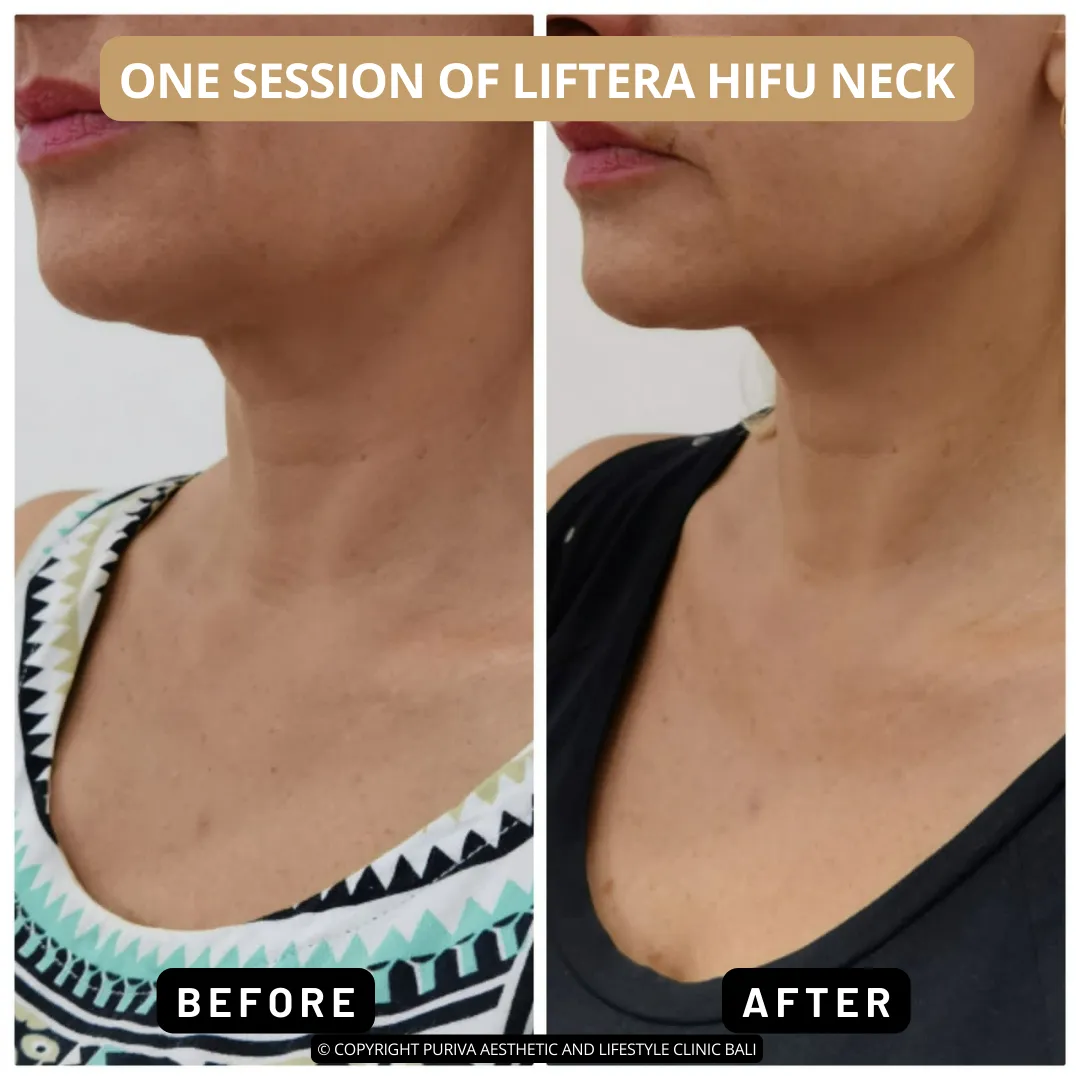 Before and after Liftera HIFU Neck in Puriva Clinic