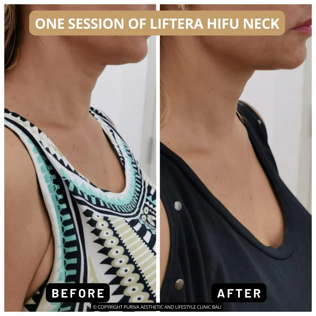 Before and after Liftera HIFU Neck One Session