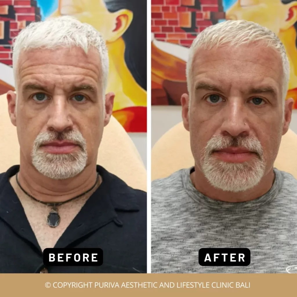 Before and after botox for men