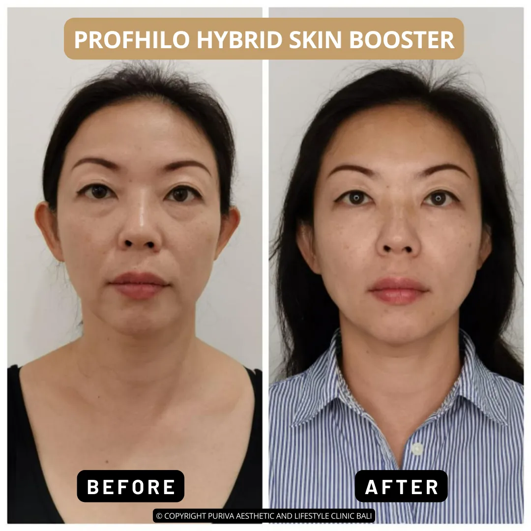 Profhilo in Bali Before And After