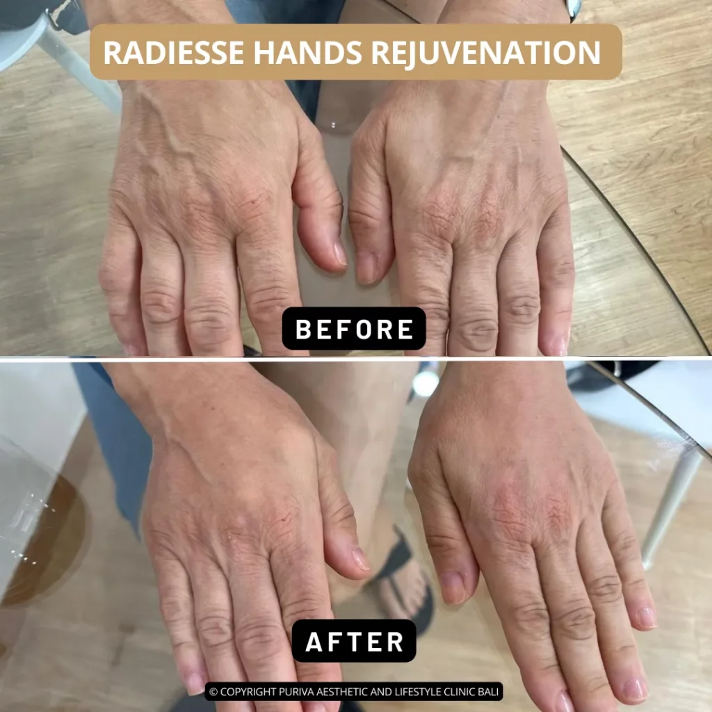 before after radiesse hands rejuvenation